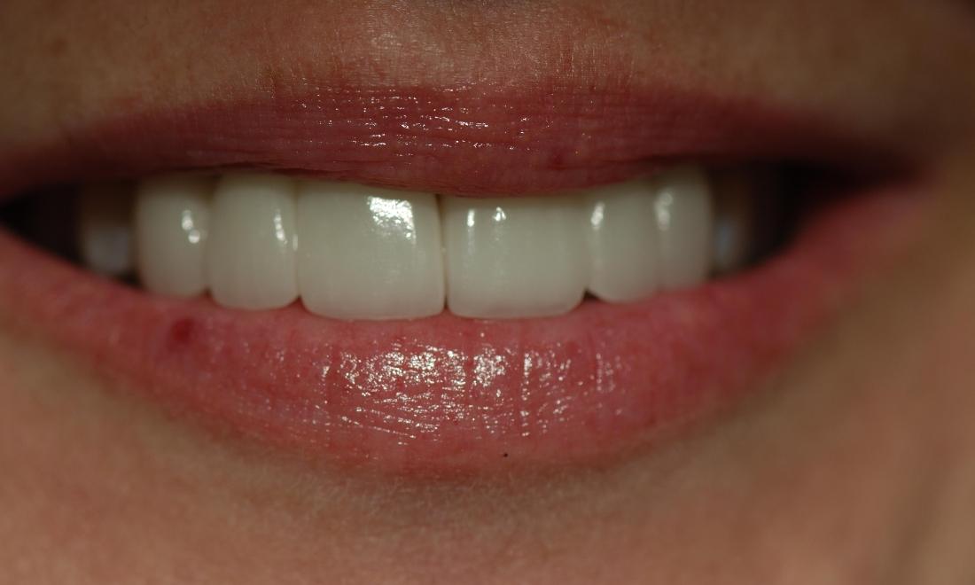 Porcelain Crowns After Surgery | McKnight Signature Dental