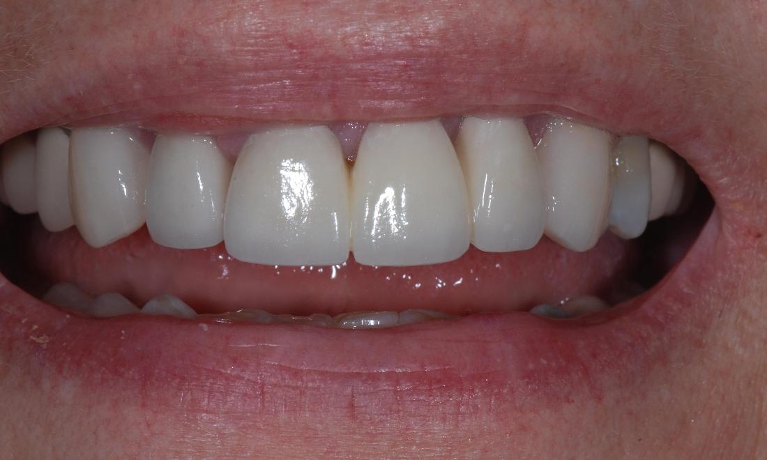 Porcelain Fused to Metal Crown After Surgery | McKnight Signature Dental
