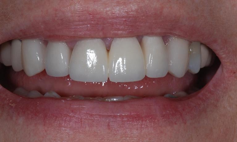 Porcelain Fused to Metal Crown After Surgery | McKnight Signature Dental