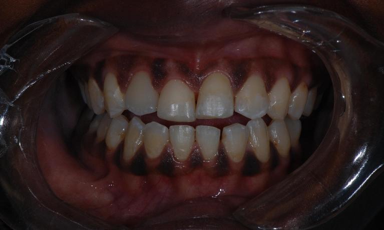 Bonded Restorations After Surgery | McKnight Signature Dental