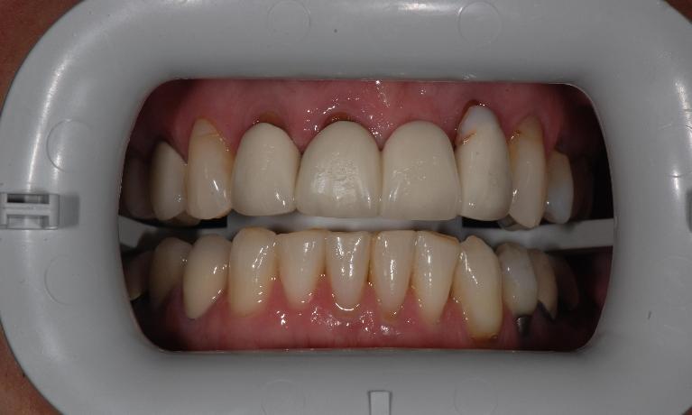 Porcelain Fused to Metal Crown Before Surgery | McKnight Signature Dental