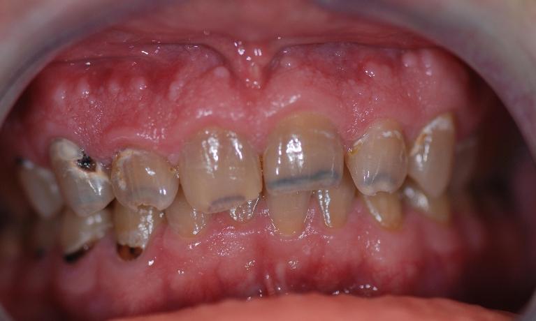 Porcelain Crowns and Composite Fillings Before Surgery | McKnight Signature Dental