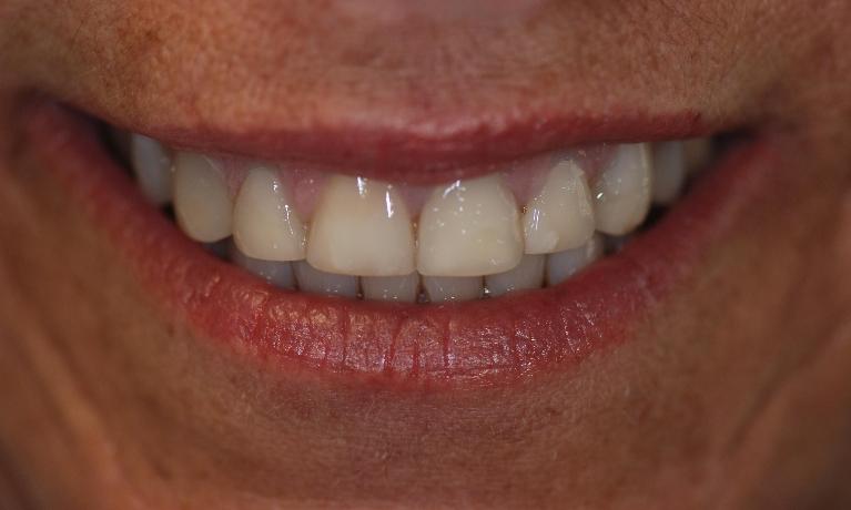 Porcelain Veneers Before Surgery | McKnight Signature Dental